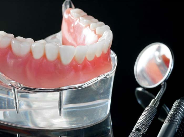 Imagem prótese dental